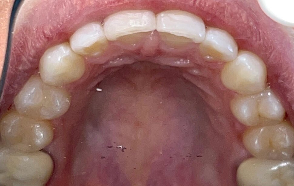 invisialign-braces-after04