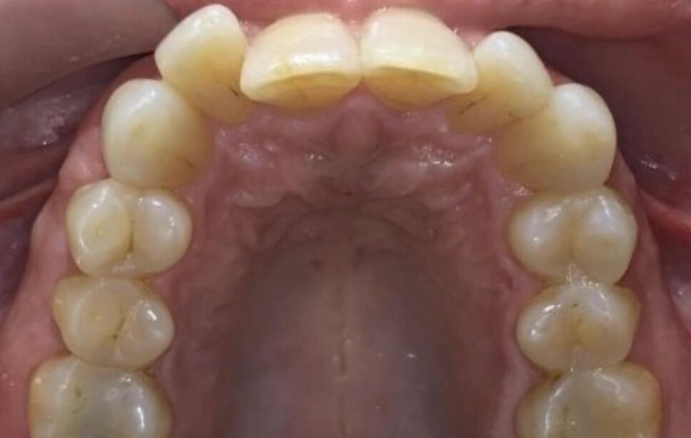 invisialign-braces-before04