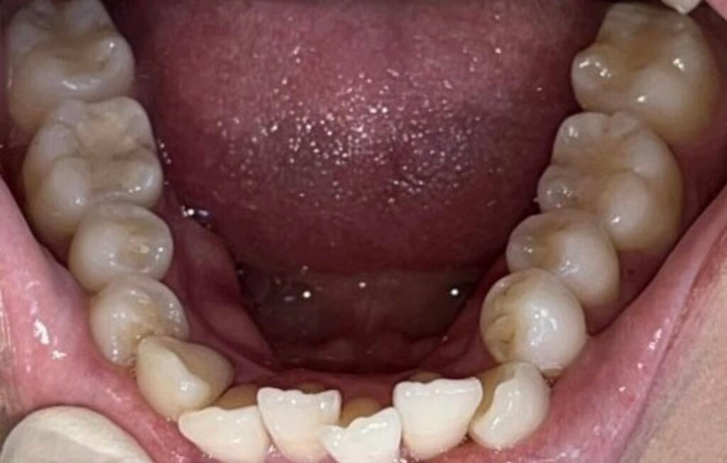 Invisalign | Before