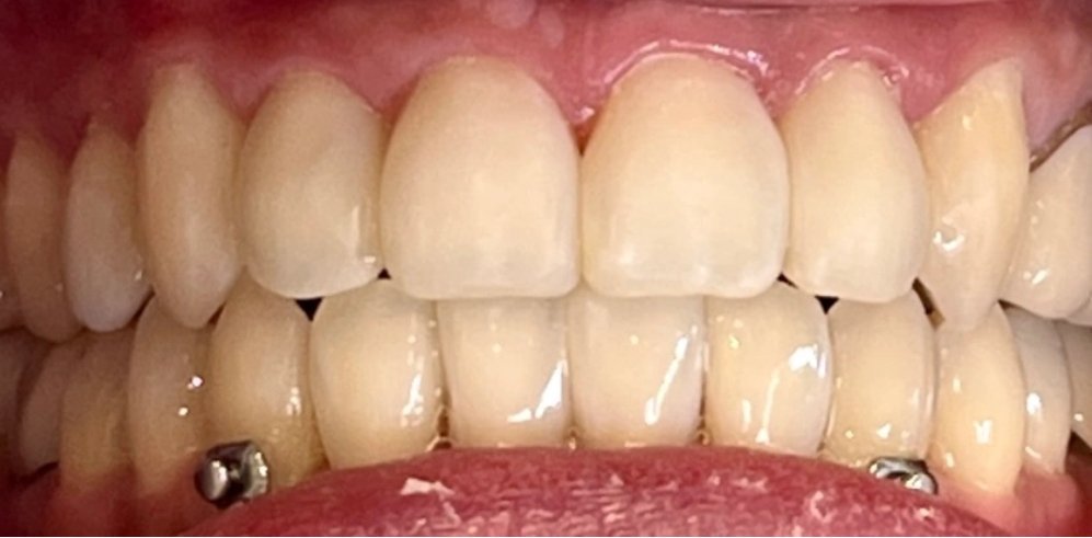 Invisalign & Veneers | After