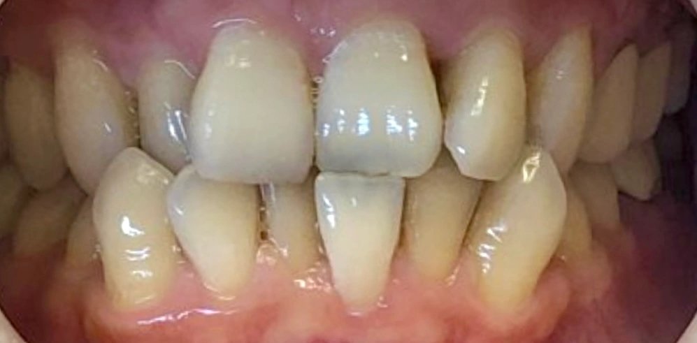 Invisalign & Veneers | Before