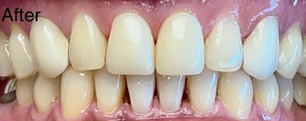 Invisalign & Veneers | After