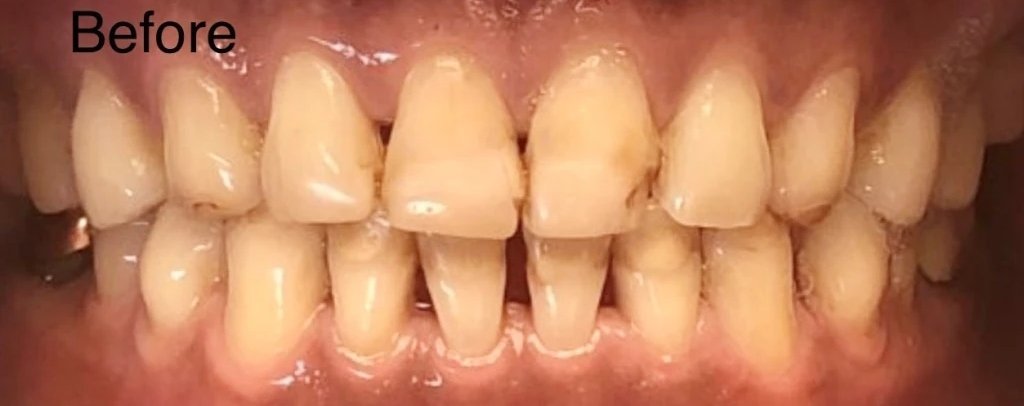 Invisalign & Veneers | Before
