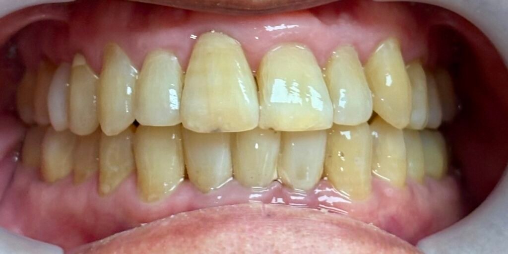 Bioclear & Invisalign | After