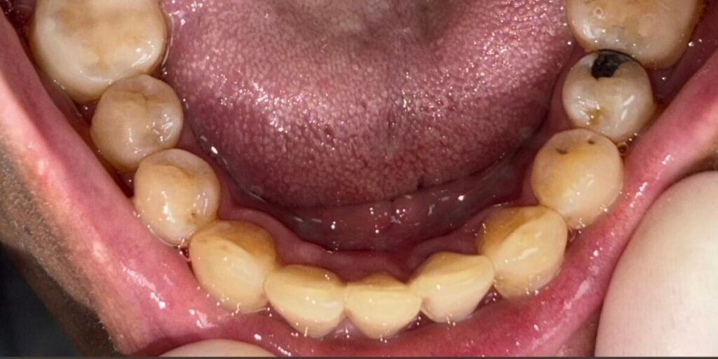 Bioclear & Invisalign | After