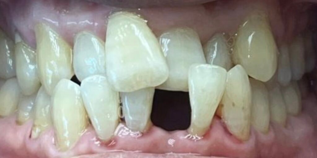 Bioclear & Invisalign | Before