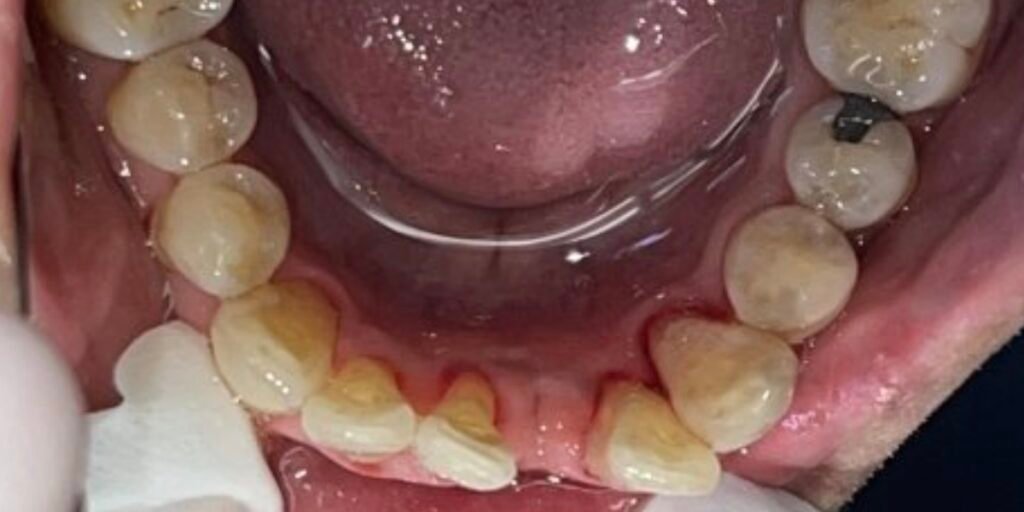 Bioclear & Invisalign | Before