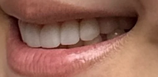 Dental Implants | After