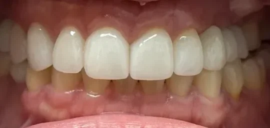 Dental Implants | After