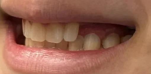 Dental Implants | Before