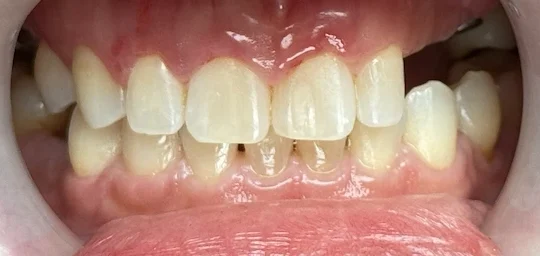Dental Implants | Before