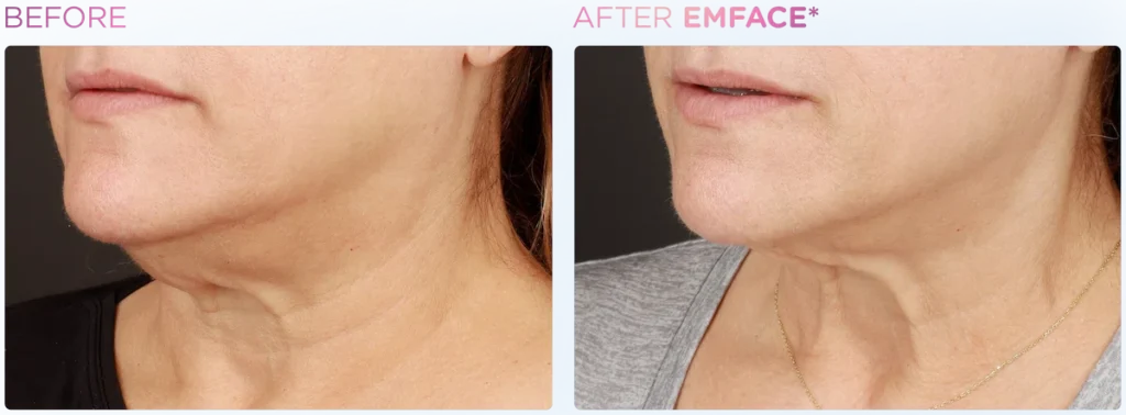 Emface before and after