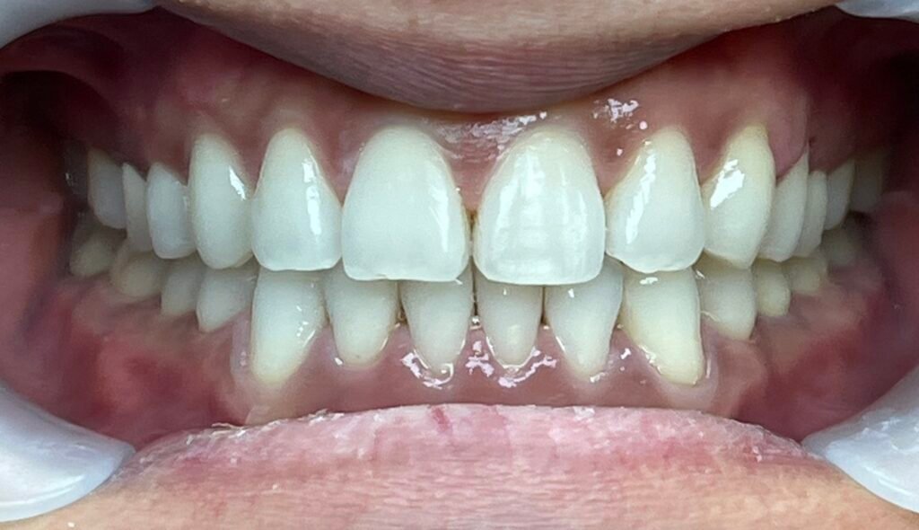 Invisalign | After