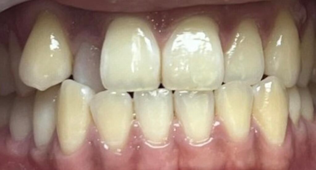 Invisalign | Before