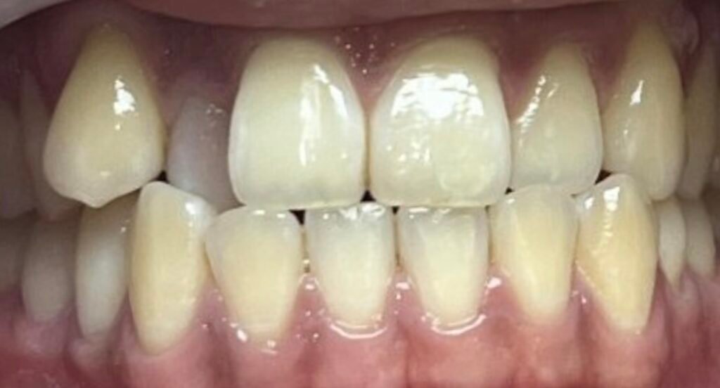 Invisalign | Before