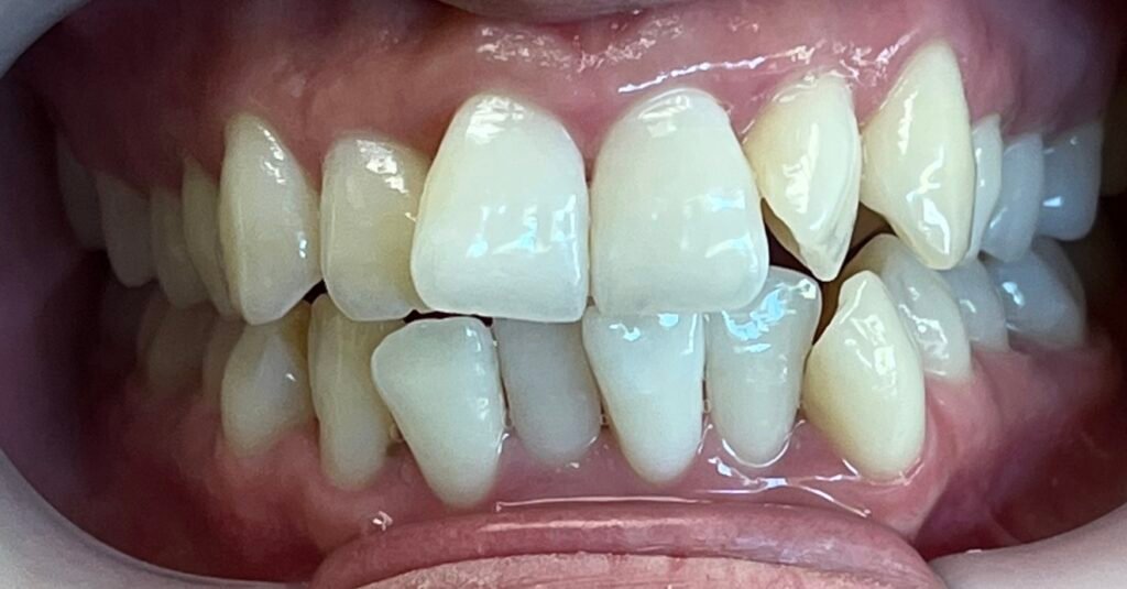 Invisalign | Before