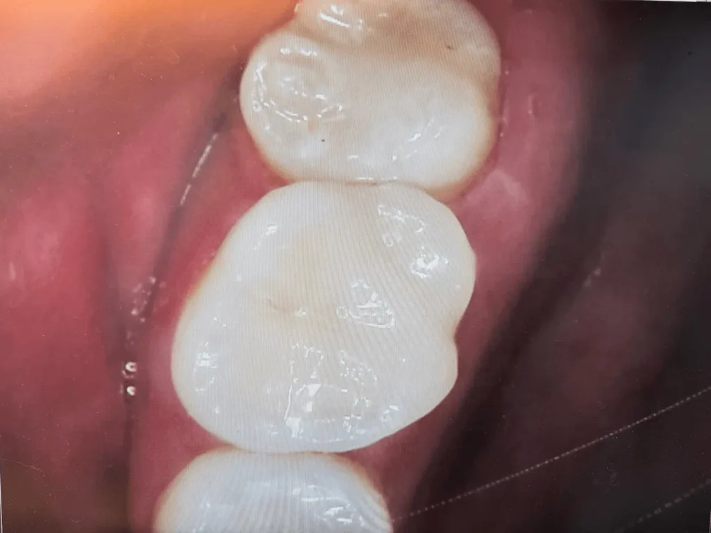 Partial Crown(Onlay) | After