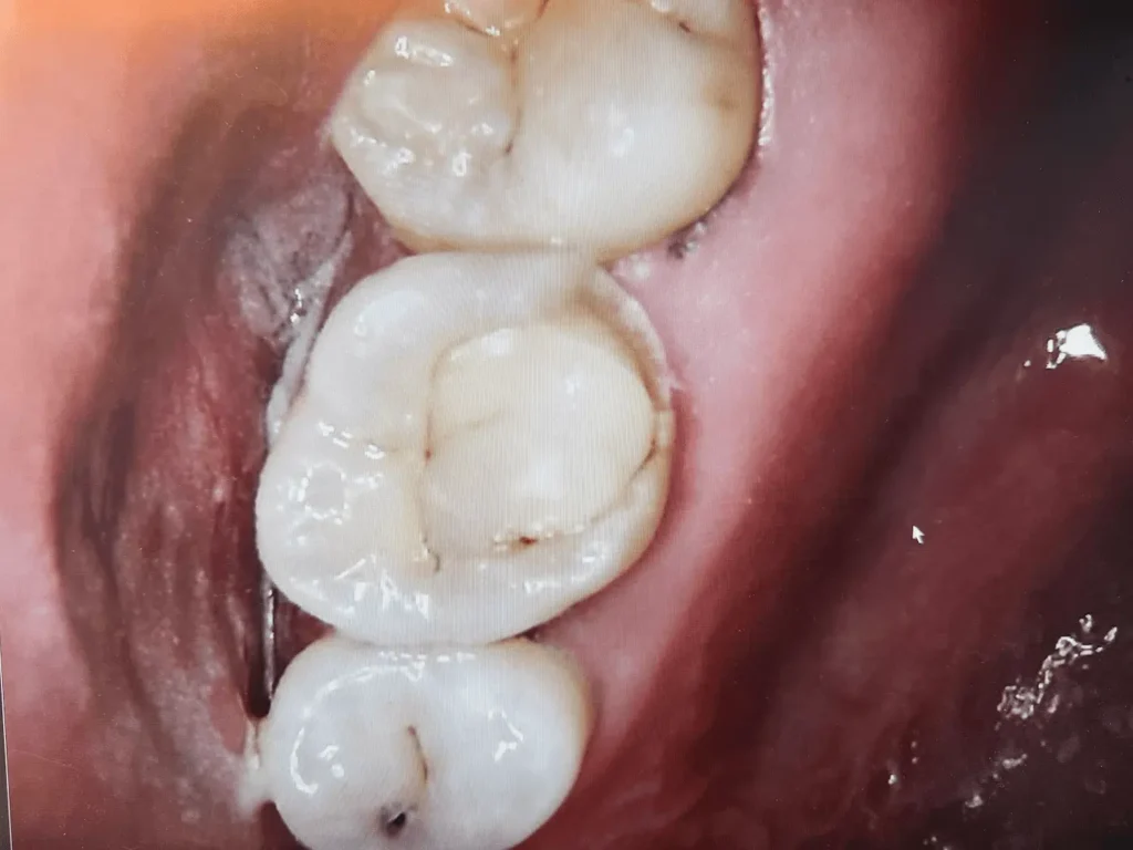 Partial Crown(Onlay) | Before