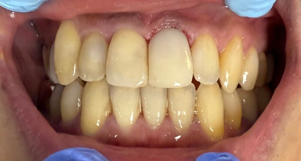 Perio & Bioclear | After