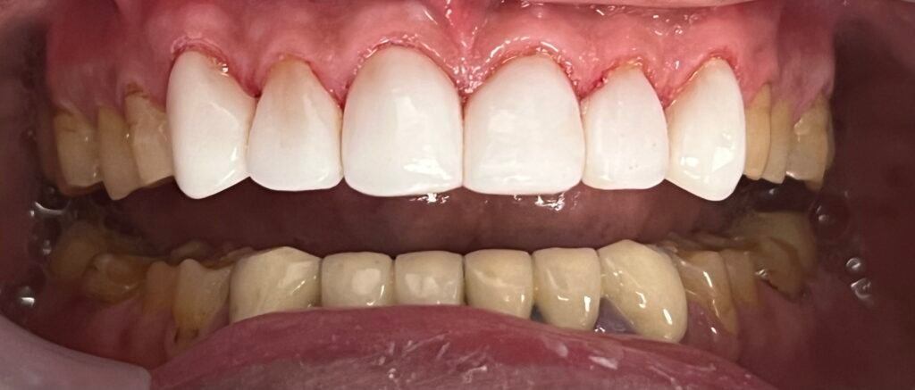 Perio & Bioclear | After