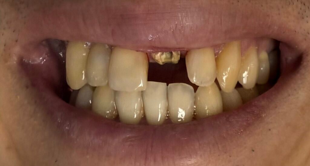 Perio & Bioclear | Before