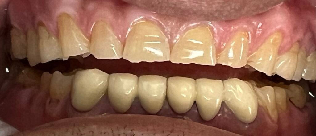 Perio & Bioclear | Before