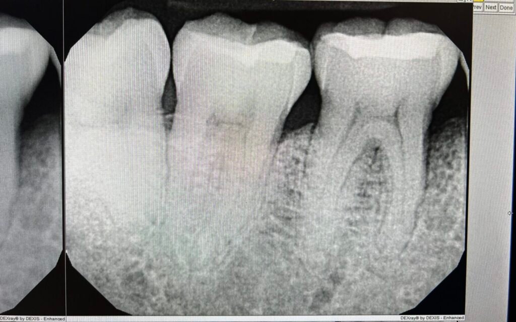 Perio & Lanap | After