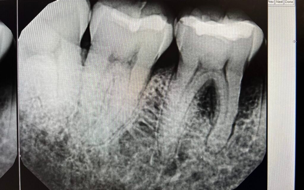 Perio & Lanap | Before