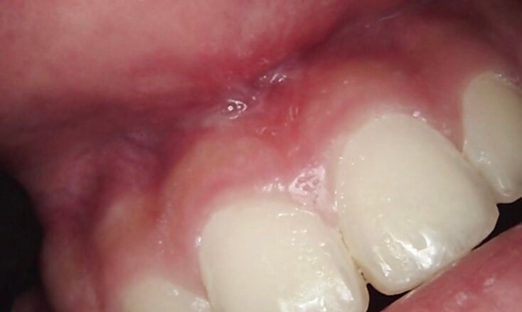 Laser Frenectomy | After