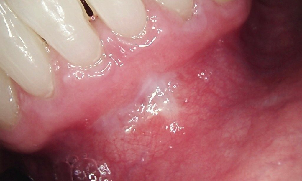 Laser Frenectomy | After