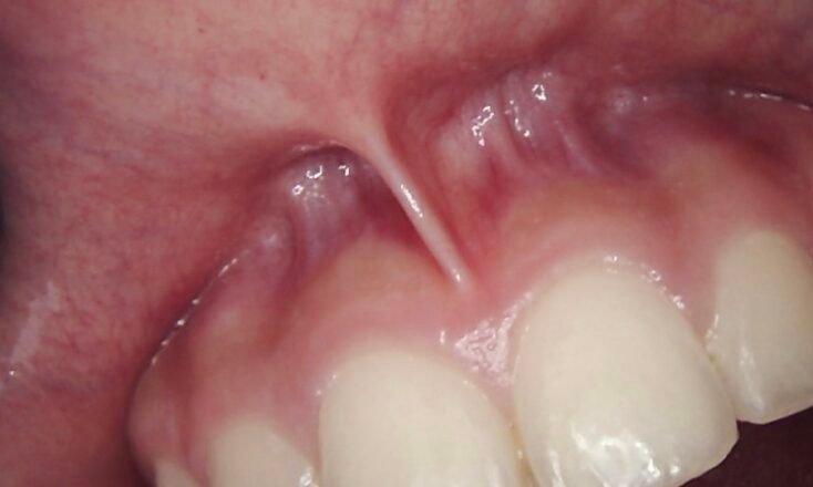 Laser Frenectomy | Before