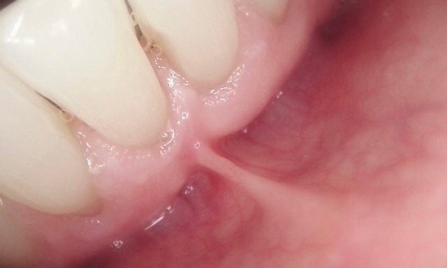 Laser Frenectomy | Before