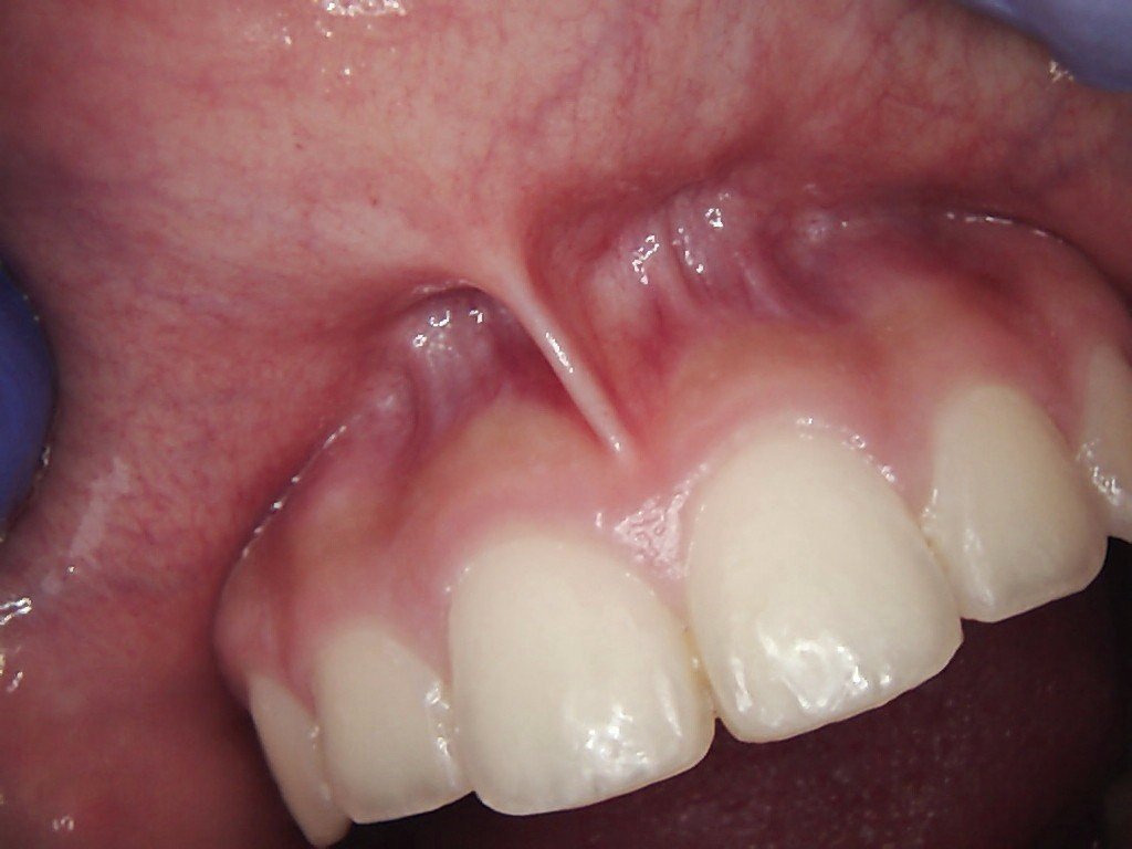 Perio | Before