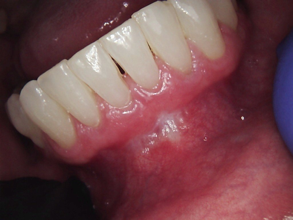 Perio | Before