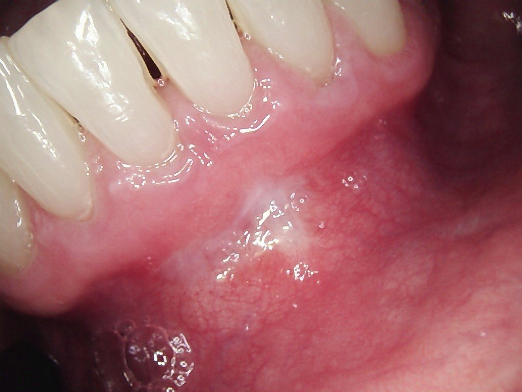 Frenectomy | After