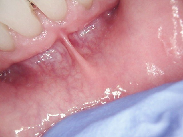 Frenectomy | Before